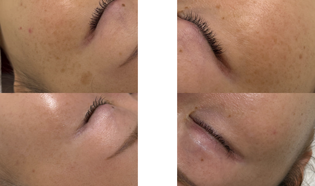 ローマピンク本社直営サロン提供症例